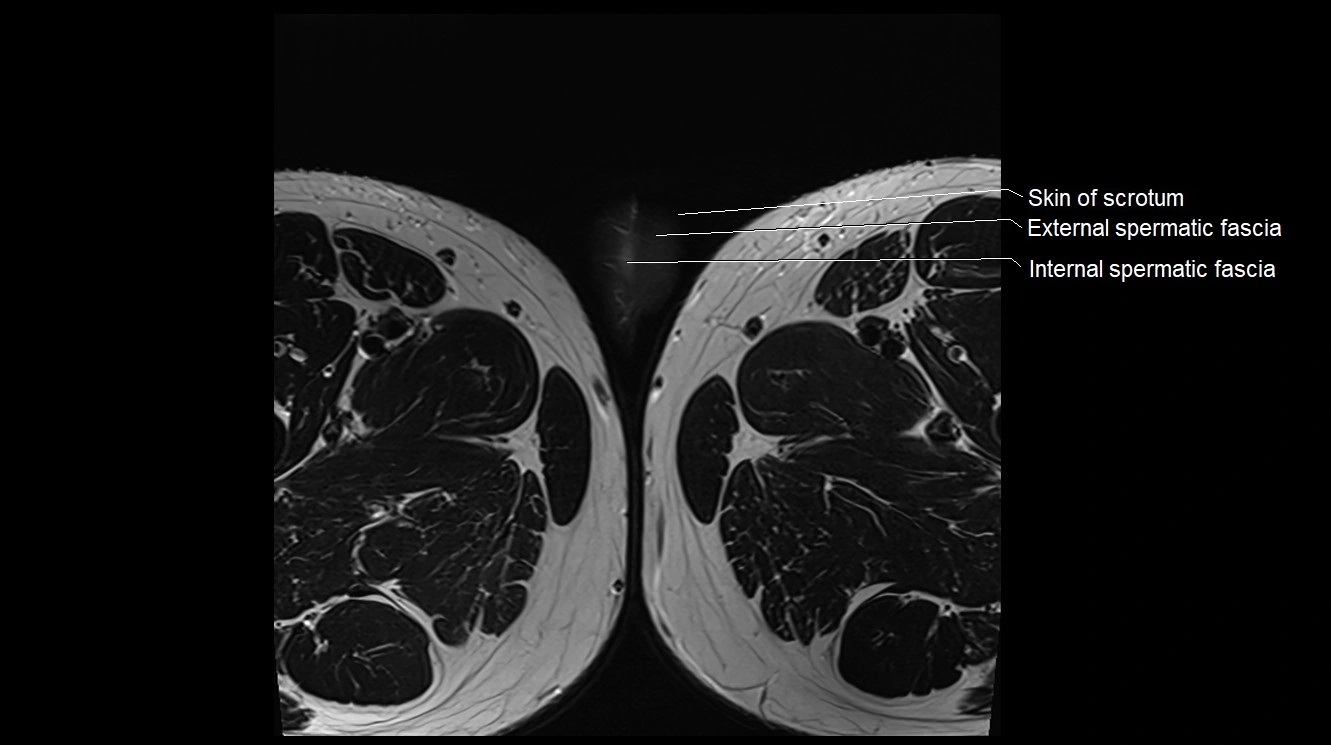 MRI 3T scrotum and penis axial cross sectional anatomy image 42.webp
